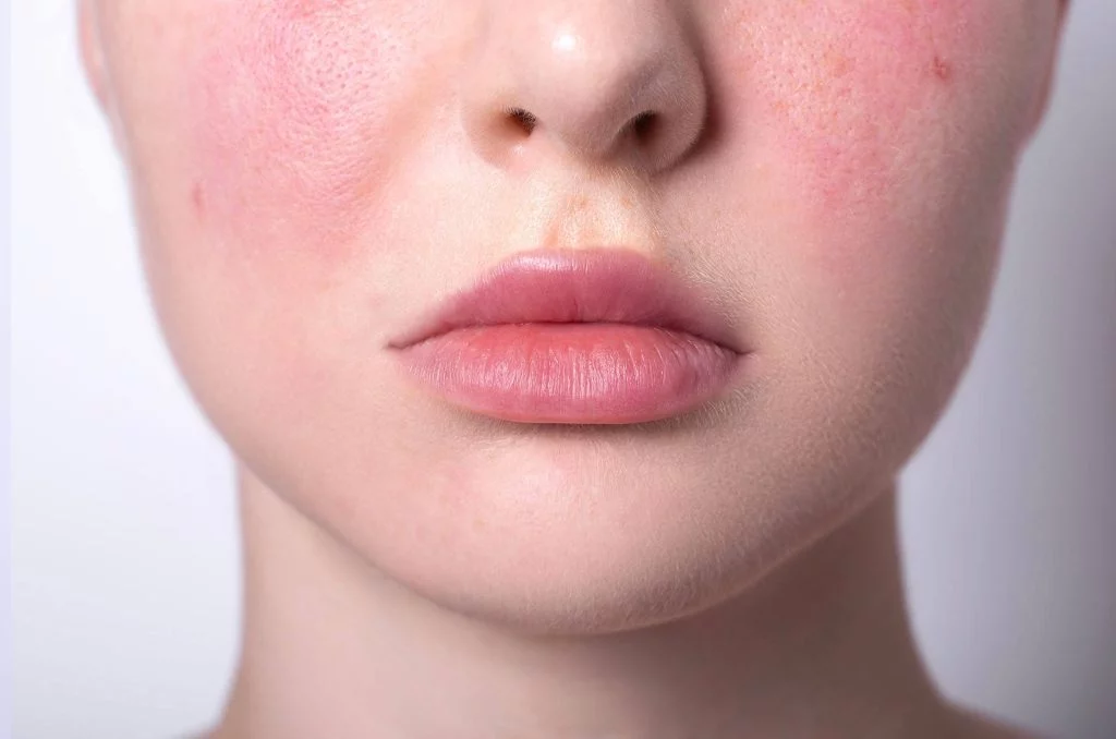 Sensitive Skin