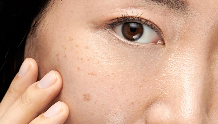 Dark Spots & Hyperpigmentation